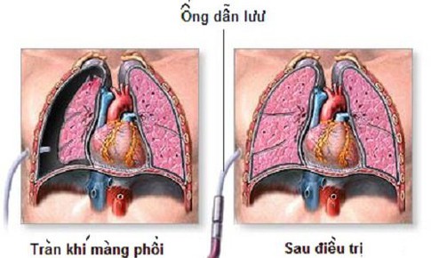 Đau ngực đột ngột, kh&#243; thở... cảnh gi&#225;c với tr&#224;n kh&#237; m&#224;ng phổi