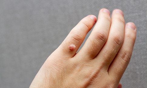 Hạt cơm - Nguyên nhân và điều trị đúng cách