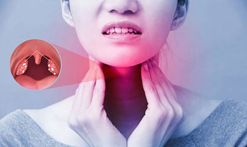 Viêm họng do liên cầu có triệu chứng gì?