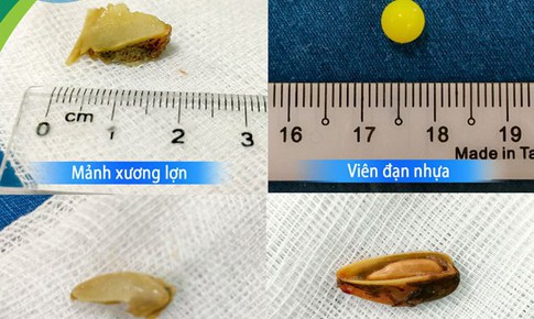 Liên tiếp có trẻ nhỏ nhập viện vì hóc dị vật đường thở, chuyên gia cảnh báo nguy hiểm