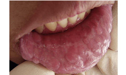 Nhiễm  HPV trong miệng c&#243; biểu hiện g&#236;?