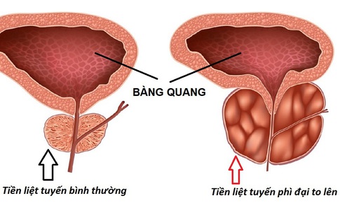 U ph&#236; đại tiền liệt tuyến: Nguy&#234;n nh&#226;n, hậu quả v&#224; phương hướng điều trị