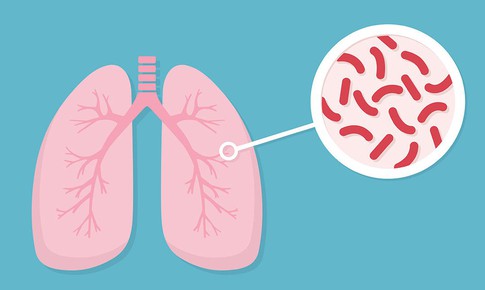 Bảo vệ hộ gia đình phơi nhiễm với bệnh nhân lao kháng thuốc
