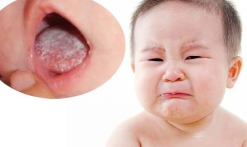 Điều trị nấm miệng ở trẻ em