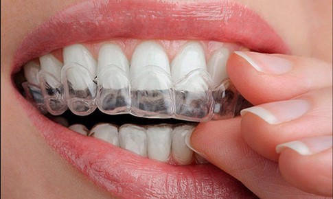 Tẩy trắng răng c&#243; l&#224;m hại men răng kh&#244;ng?