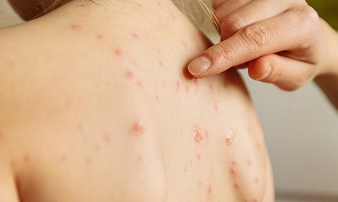 Những lý do khiến mụn lưng tiến triển dai dẳng và cách khắc phục