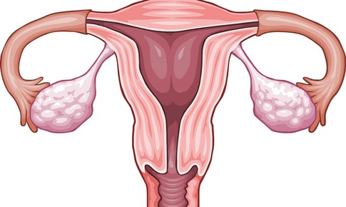 Nguyên nhân tiềm ẩn gây đau buồng trứng cần lưu ý