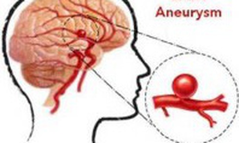 Ph&#225;t hiện sớm ph&#236;nh động mạch n&#227;o