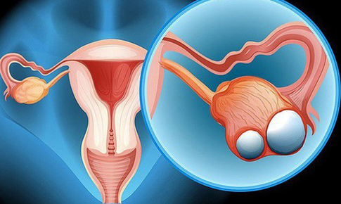 Các yếu tố nguy cơ gây ung thư buồng trứng