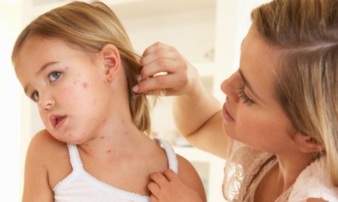 Lưu ý khi dùng thuốc bôi cho người bệnh tay chân miệng