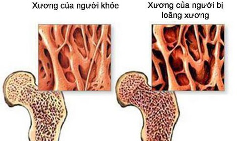 4 loại thực phẩm c&#243; thể g&#226;y lo&#227;ng xương