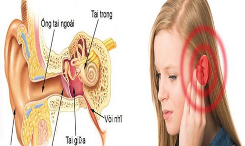 M&#249;a h&#232; cảnh gi&#225;c với nhọt ống tai