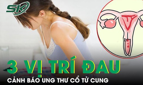 3 vị tr&#237; đau cảnh b&#225;o ung thư cổ tử cung