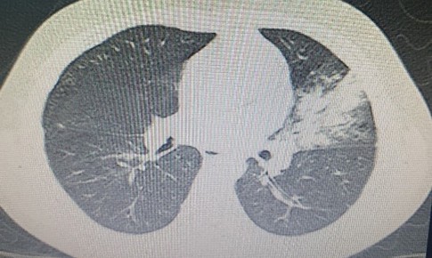 Vi&#234;m phổi do Mycoplasma: Dấu hiệu v&#224; c&#225;ch ph&#242;ng ngừa