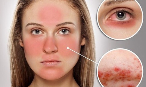 Biểu hiện của bệnh lupus ban đỏ hệ thống v&#224; c&#225;ch điều trị