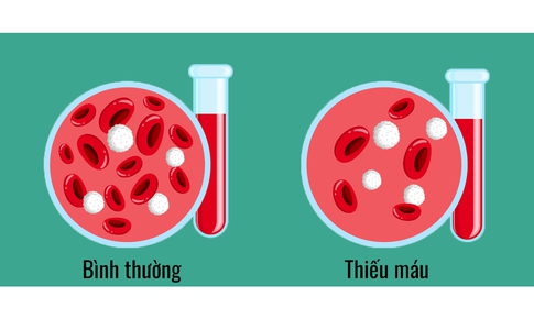 Thiếu m&#225;u: Nguy&#234;n nh&#226;n, dấu hiệu v&#224; c&#225;ch điều trị