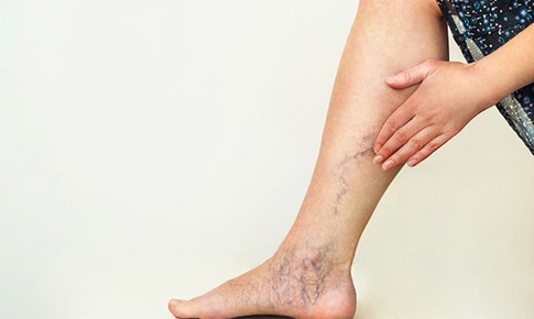 Người bị suy giãn tĩnh mạch chân cần lưu ý những điều này để tránh bị nặng hơn