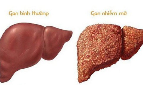 Bài thuốc từ trạch tả cải thiện gan nhiễm mỡ
