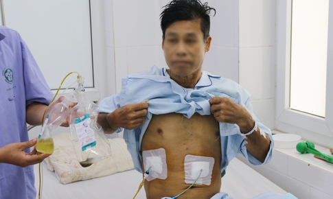 Mệt mỏi kéo dài, người đàn ông tá hỏa khi thấy sán lá gan chui ra từ trong dịch mật