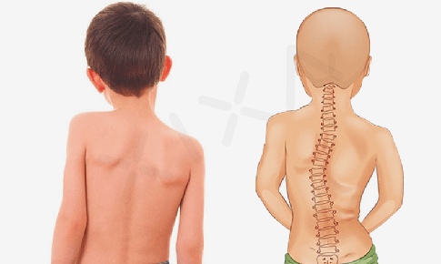 Vẹo cột sống ở trẻ nguy&#234;n nh&#226;n, biểu hiện v&#224; c&#225;c biện ph&#225;p ph&#242;ng ngừa