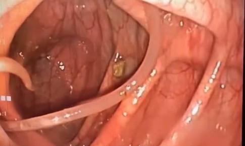 Giun đũa 10cm sống trong lòng đại tràng, cách giúp phát hiện sớm