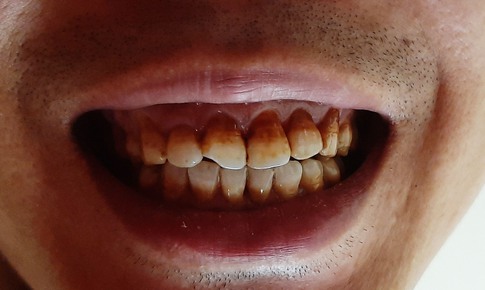 6 bệnh răng miệng do h&#250;t thuốc g&#226;y ra &#237;t người biết