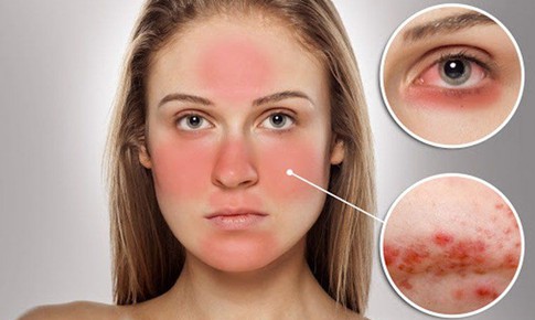 Thuốc trị vi&#234;m da tiết b&#227;