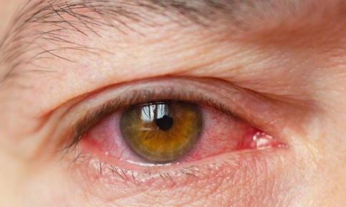 C&#225;c loại thuốc phổ biến trị kh&#244; mắt cho d&#226;n văn ph&#242;ng