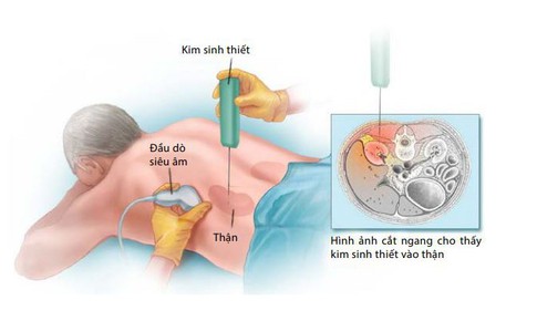 Khi n&#224;o phải sinh thiết thận?