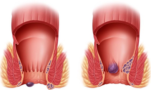 Bị trĩ c&#243; cần phải phẫu thuật?
