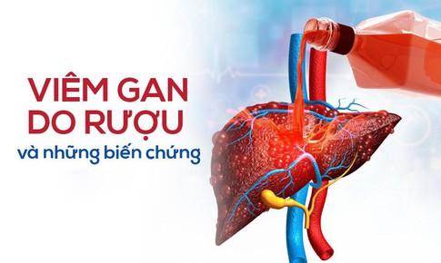 Vi&#234;m gan do rượu, bia v&#224; những biến chứng