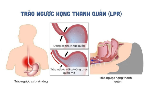 L&#253; giải nguy&#234;n nh&#226;n ho, vi&#234;m họng do tr&#224;o ngược dạ d&#224;y