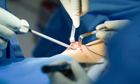 Ti&#234;n phong ứng dụng thế hệ dao Ultrasonic surgical scalpel trong phẫu thuật n&#226;ng ngực