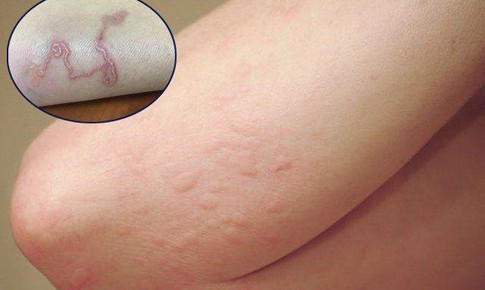 7 dấu hiệu nhiễm sán chó ở người không thể bỏ qua