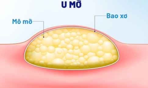 U mỡ có nguy hiểm không?