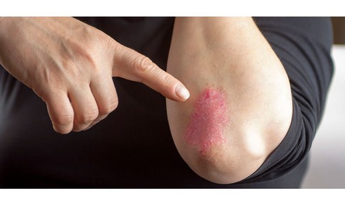Liệu ph&#225;p giảm đau, vi&#234;m cho người bệnh vi&#234;m khớp vẩy nến