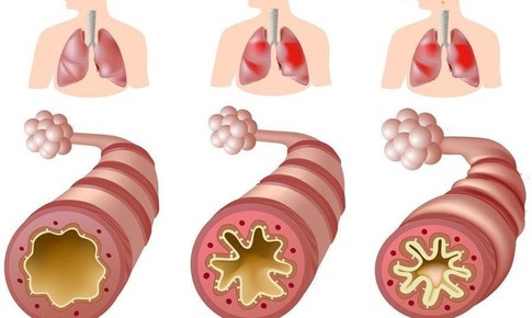 B&#225;o động 2/3 bệnh nh&#226;n hen phế quản đang lạm dụng thuốc cắt cơn