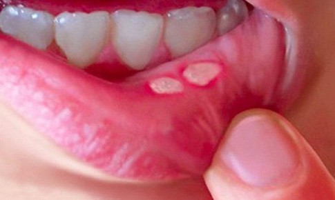 L&#224;m g&#236; khi trẻ bị vi&#234;m lo&#233;t miệng?