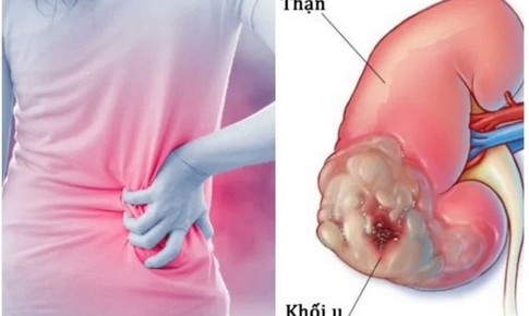 Sụt c&#226;n nhanh c&#243; phải ung thư thận?