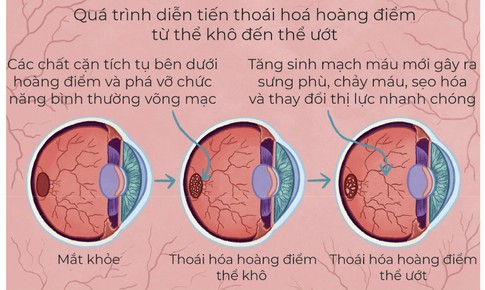 Tho&#225;i h&#243;a ho&#224;ng điểm tuổi gi&#224; - đừng bỏ qu&#234;n đ&#244;i mắt mẹ cha