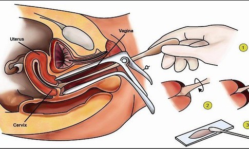 Thuốc v&#224; c&#225;c phương ph&#225;p điều trị bệnh loạn sản cổ tử cung