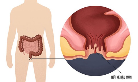 C&#226;u hỏi thường gặp li&#234;n quan đến nứt kẽ hậu m&#244;n