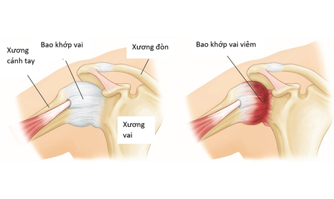 Vi&#234;m ch&#243;p xoay: Nguy&#234;n nh&#226;n, triệu chứng, c&#225;ch điều trị v&#224; c&#225;c biện ph&#225;p ph&#242;ng ngừa