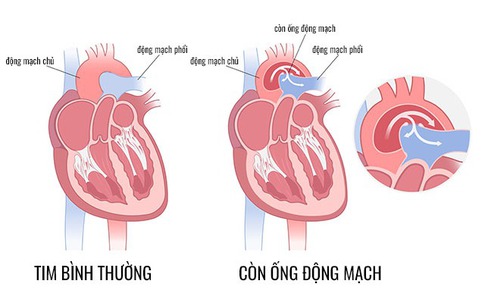 C&#226;u hỏi thường gặp về c&#242;n ống động mạch