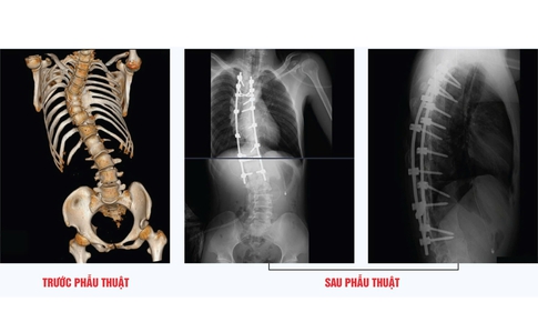 Phẫu thuật chỉnh cột sống h&#236;nh chữ &#39;S&#39; th&#224;nh c&#244;ng cho thanh ni&#234;n 23 tuổi