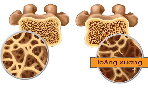 Lo&#227;ng xương, ai cần đo mật độ xương?