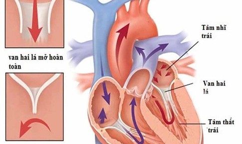 Van hai l&#225;: Nguy&#234;n nh&#226;n, triệu chứng, ph&#242;ng bệnh v&#224; c&#225;ch điều trị