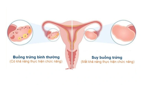 Suy buồng trứng: Nguy&#234;n nh&#226;n, triệu chứng, c&#225;ch ph&#242;ng ngừa