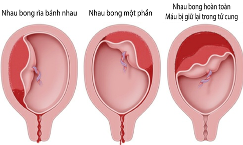 Nhau bong non: Nguy&#234;n nh&#226;n, triệu chứng, c&#225;ch điều trị v&#224; ph&#242;ng ngừa