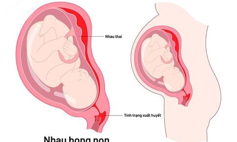 C&#225;c c&#226;u hỏi thường gặp li&#234;n quan đến nhau bong non